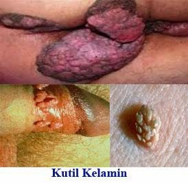 Illustration for article titled Menyembuhkan Kutil Kelamin
